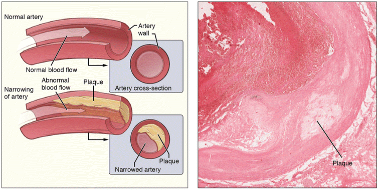 动脉粥样硬化及动脉斑块简图.(图片来源:wikimedia commons)