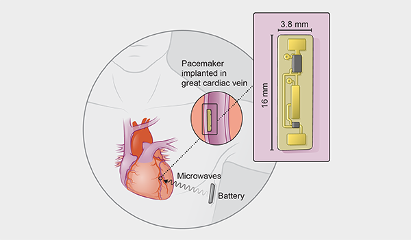 无线心脏起搏器问世