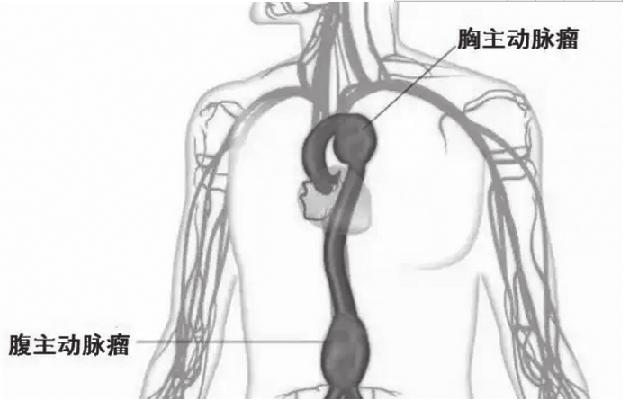 主动脉瘤就像个气球,说炸就炸