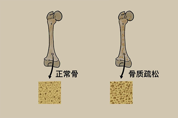 骨头;骨质疏松