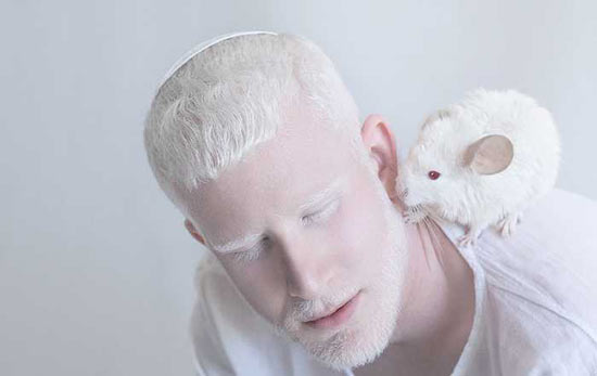 【国际罕见病日系列谈】白化病的唯一“解药”:产前基因诊断