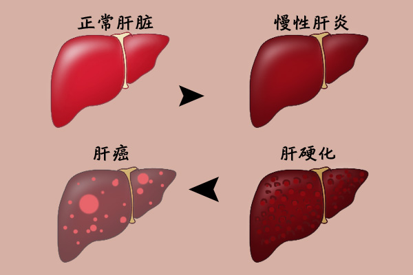 全国爱肝日;远离肝癌;怎么预防肝癌;