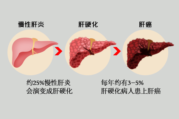 全国爱肝日;远离肝癌;怎么预防肝癌;