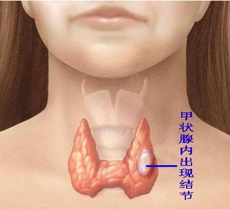 甲状腺结节 甲状腺结节