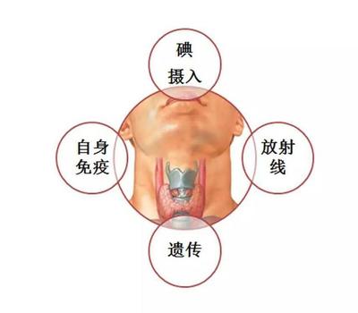 甲状腺癌 甲状腺癌